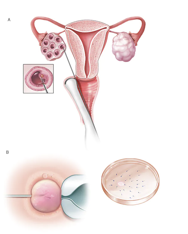 메디컬 테크놀로지 시장 확대되는 가운데 불임 금융 시장도 커져(As the medical tech market expands, so does fertility financing)